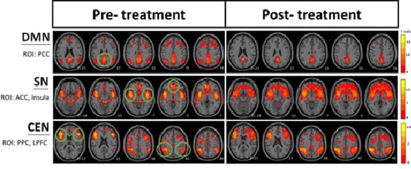 “Una seduta, tre reti cerebrali”: cosa racconta un caso rs-fMRI prima/dopo terapia craniosacrale nella demenza precoce fig 1 2 -